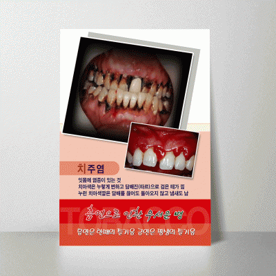 H69.흡연-치주염